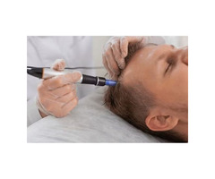 Stem Cell Therapy For Hair Loss