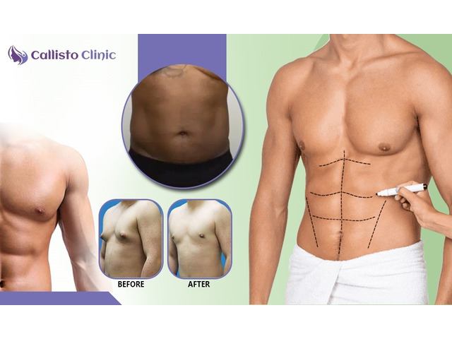 Safe & Effective Liposuction in Surat – Callisto Clinic