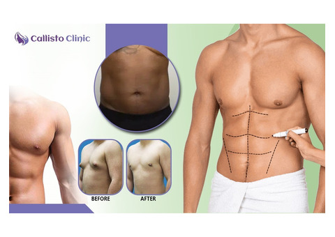 Safe & Effective Liposuction in Surat – Callisto Clinic