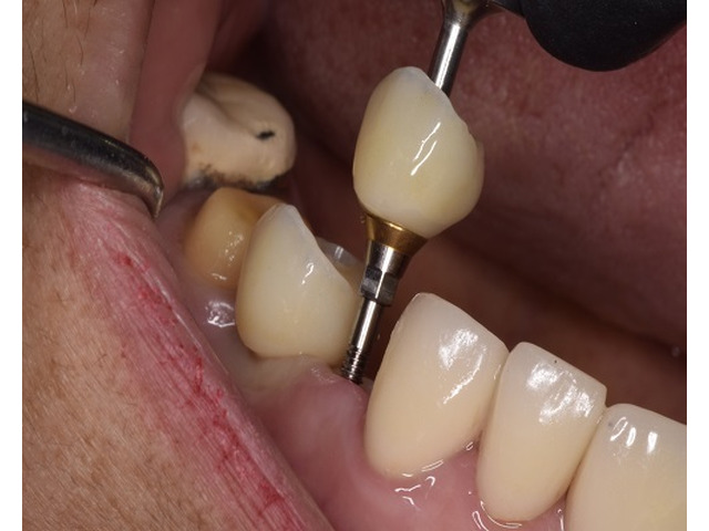 Get that Ideal Smile Makeover from the Best Tijuana Dentist