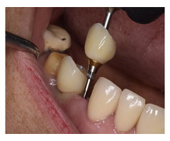 Get that Ideal Smile Makeover from the Best Tijuana Dentist