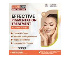 Best Advanced Xanthelasma Treatment in india