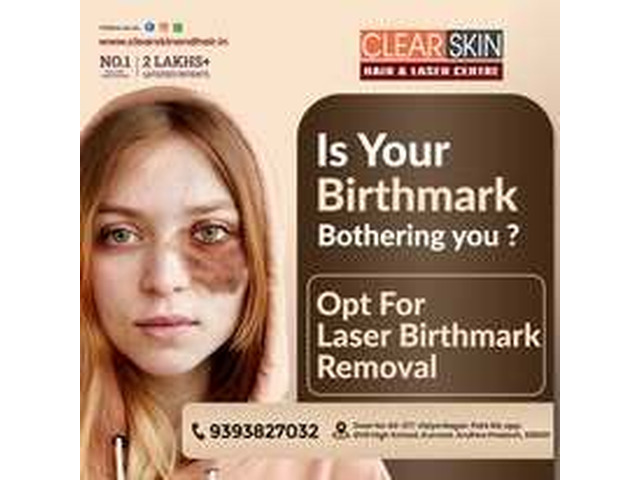 Advance Tattoo Removal Treatment  in india