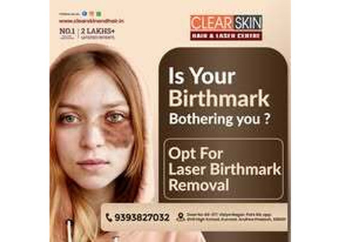 Advance Tattoo Removal Treatment  in india