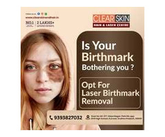 Advance Tattoo Removal Treatment  in india