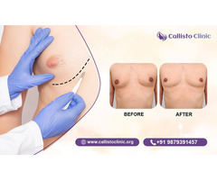Callisto Clinic Trusted Male Breast Reduction Expert