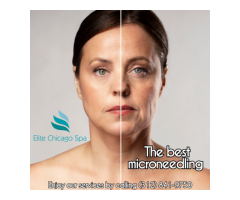 The best microneedling Chicago