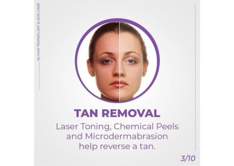 tan removal treatment in chennai