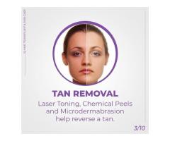 tan removal treatment in chennai