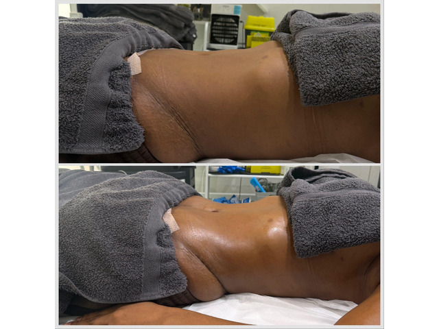 Manual Lymphatic Drainage (MLD) – Post Operative Recovery Guide FAQs