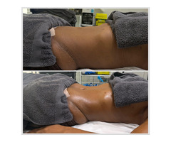 Manual Lymphatic Drainage (MLD) – Post Operative Recovery Guide FAQs