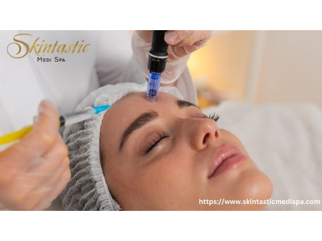 Advanced Potenza Microneedling Near Me for Youthful Skin