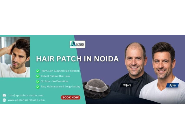 Best Hair Patch in Noida, Hair Patch Solutions - Apolo Hair Studio