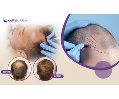 Best Hair Transplant Treatment in Surat - Callisto Clinic