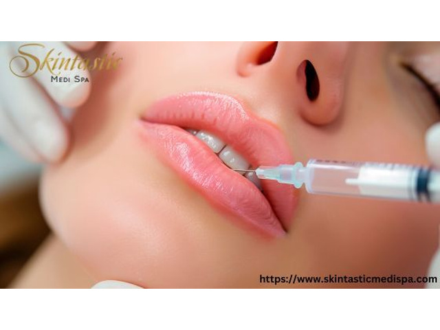 Lip Fillers Riverside for Beautiful Volume Boost
