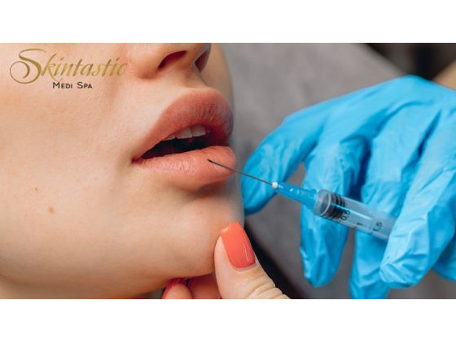Affordable Lip Fillers Riverside for Perfect Volume