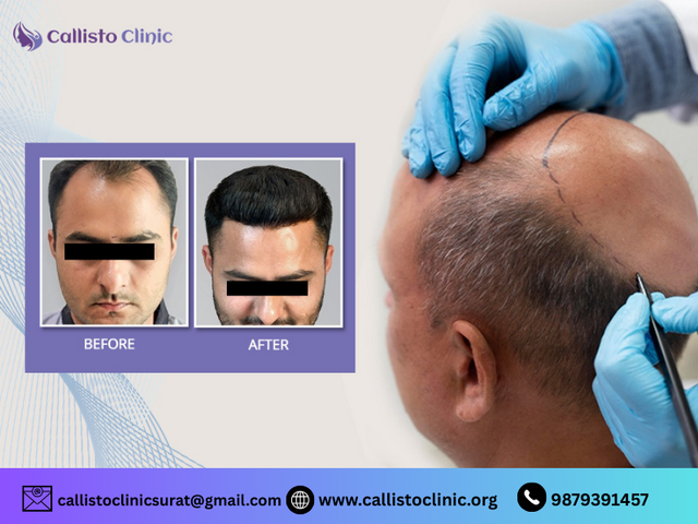 Get Long-Lasting Results with Best Hair Transplant in Surat