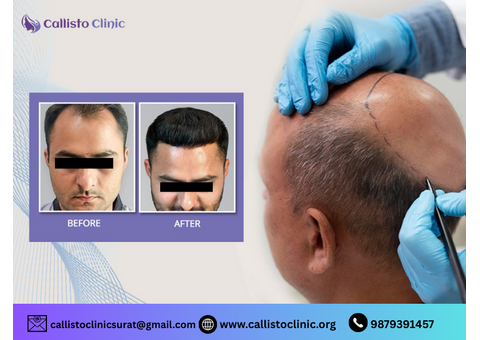 Get Long-Lasting Results with Best Hair Transplant in Surat