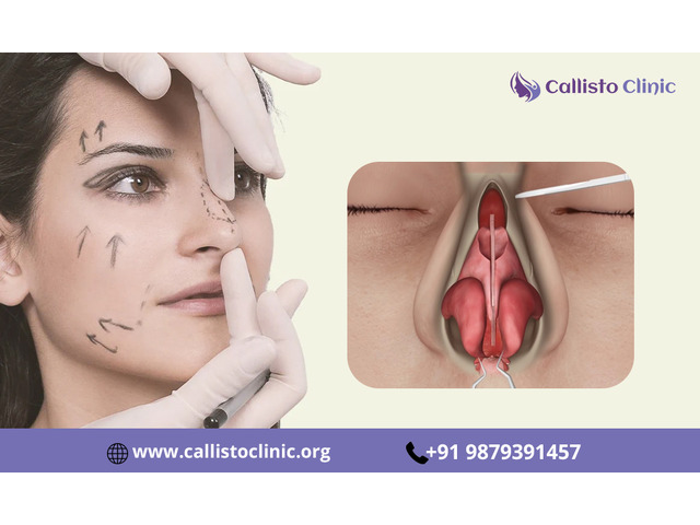 Cosmetic Rhinoplasty in Surat for a Balanced Facial Look