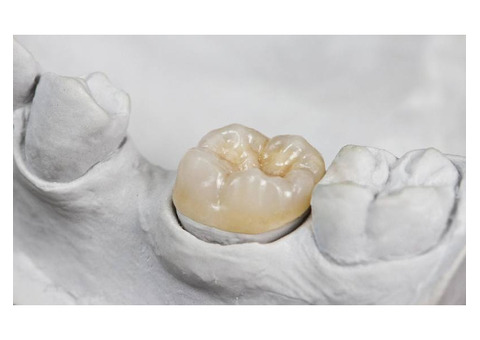Dental Inlay, Onlay, Fillings, or Crowns: Which is Best for You