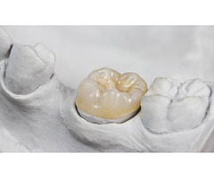 Dental Inlay, Onlay, Fillings, or Crowns: Which is Best for You
